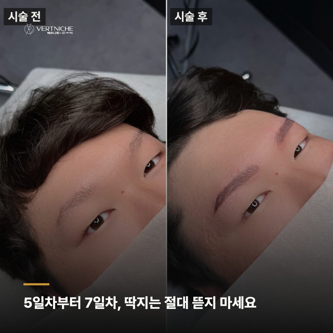 5~7일차 탈각 시기 딱지 관리 주의사항