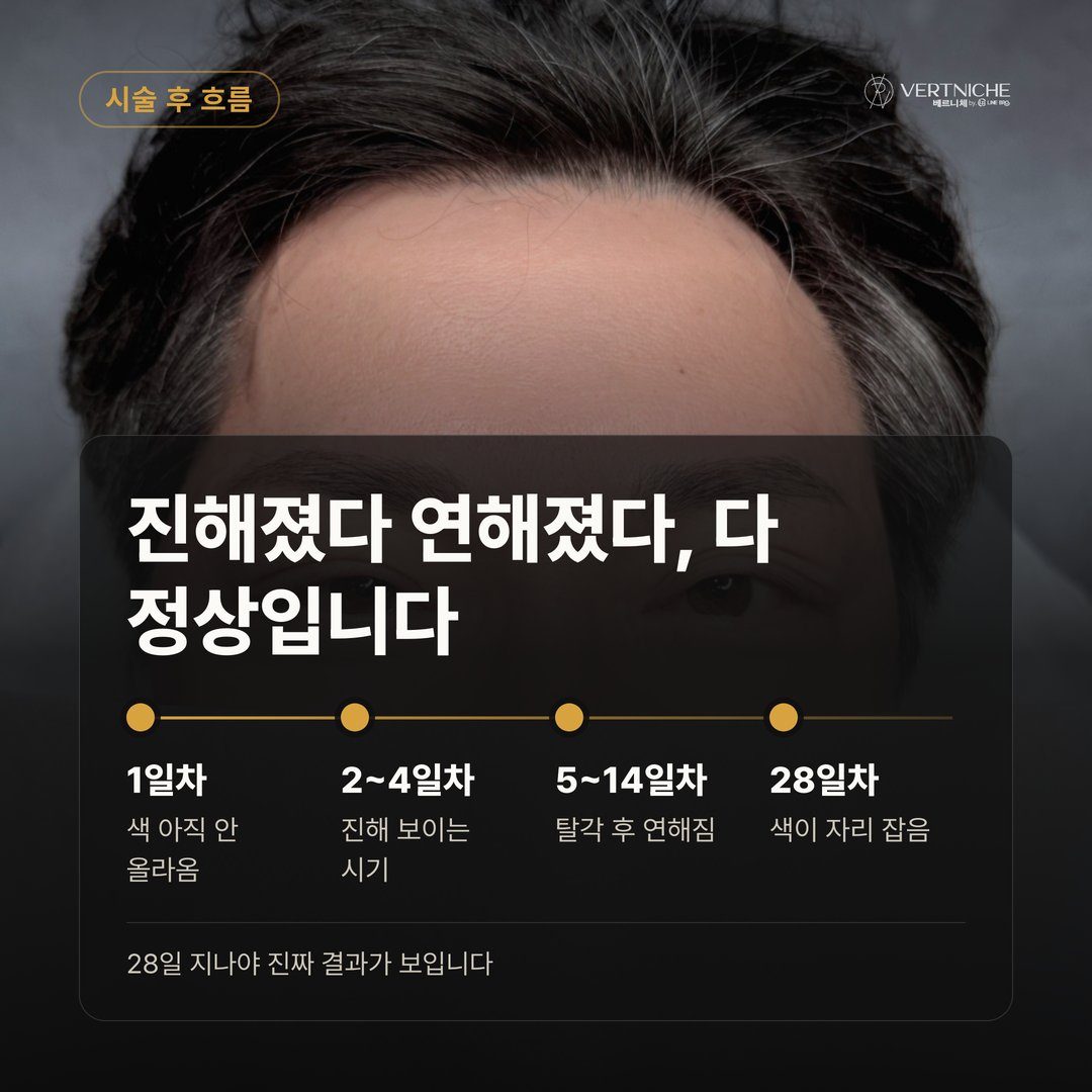 눈썹문신 시술 후 1일차부터 28일차까지 회복 흐름